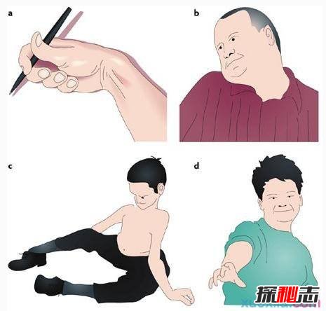 中國世界首例舞蹈豬,亨廷頓氏舞蹈癥是什么??？